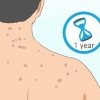Sbarazzati delle cicatrici da acne sulla schiena