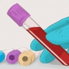 Aumento della velocità di filtrazione glomerulare