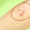 Riconoscere il morbillo