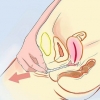 Rimuovere un preservativo sloggiato dal tuo corpo