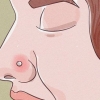Trattare un piercing al naso infiammato