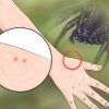 Identificare un morso di ragno