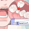 Riparazione di una corona dentale perduta