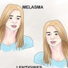 Trattamento dell'iperpigmentazione