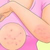 Trattare la scabbia