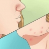 Sbarazzati dell'acne in modo rapido e naturale