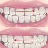 Smetti di digrignare i denti nel sonno