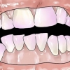 Rimuovere la placca dentale
