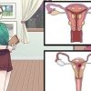 Trattare le cisti vaginali