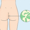 Sbarazzati dell'acne sui glutei