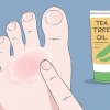Curare l'eczema del nuotatore: si può fare naturalmente?