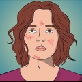 Rimedio dell'acne con formazione di cisti