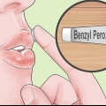 Tratta rapidamente l'acne intorno alle labbra