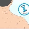 Sbarazzati delle cicatrici da acne sulla schiena