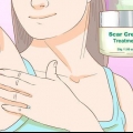 Come sbarazzarsi di bolle causate cicatrici