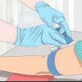 Prelievo di sangue da una vena problematica