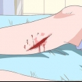 Trattare la cellulite