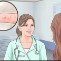 Alleviare i sintomi della dermatite spongiotica