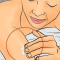 Trattare l'eczema