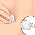 Trattare un piercing all'ombelico irritato