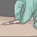 Leggere un test cutaneo per la tubercolosi