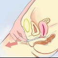 Rimuovere un preservativo sloggiato dal tuo corpo