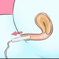 Rimuovere un tampone