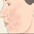 Cura la pelle troppo esfoliata