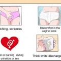 Trattare un'infezione da lievito vaginale