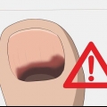 Come trattare un'unghia nera