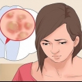Trattamento delle verruche genitali nelle donne