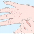 Trattamento dell'eczema alle mani