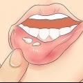 Riconoscere l'herpes