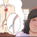 Recupero da un'angiografia