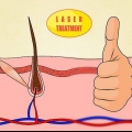 Ottenere il massimo dall'epilazione laser