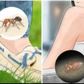 Riconosci le punture di insetti