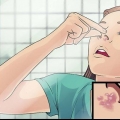Trattare l'herpes labiale nel naso