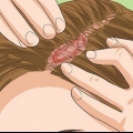 Riconoscere la psoriasi del cuoio capelluto