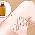 Trattare la tigna: può farlo naturalmente?