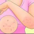 Trattare la scabbia