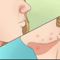 Sbarazzati dell'acne in modo rapido e naturale