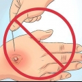 Cure bolle: si può fare naturalmente?