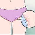 Riconoscere i sintomi del cancro alle labbra