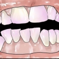 Rimuovere la placca dentale