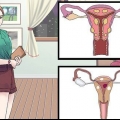Trattare le cisti vaginali