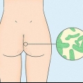 Sbarazzati dell'acne sui glutei