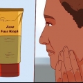 Sbarazzati di un brufolo con il gel di aloe vera