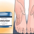 Trattare l'eczema invernale