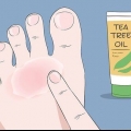 Curare l'eczema del nuotatore: si può fare naturalmente?
