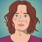 Rimedio dell'acne con formazione di cisti